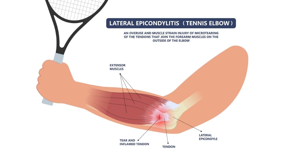 tennis elbow
