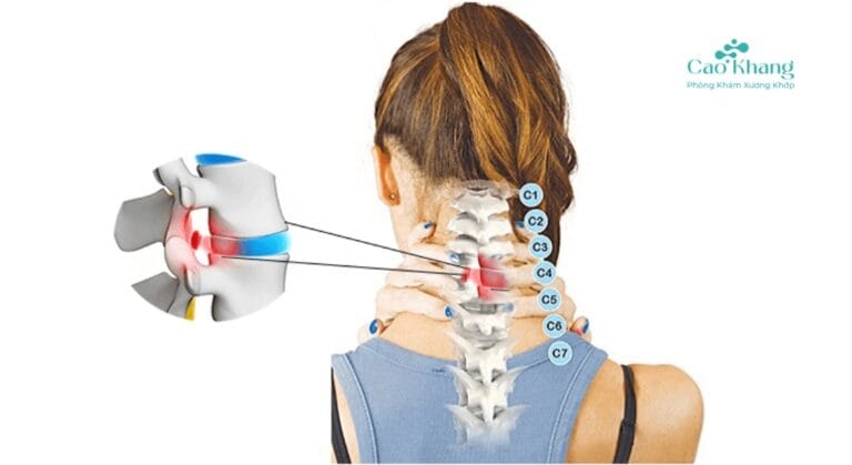 thoát vị đĩa đệm đốt sống cổ
