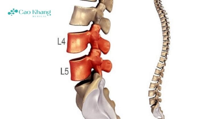 thoát vị đĩa đệm l4 l5