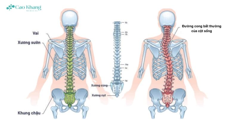 vẹo cột sống ngực (2)