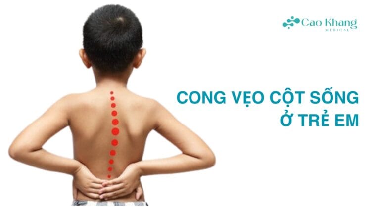 vẹo cột sống ở trẻ em