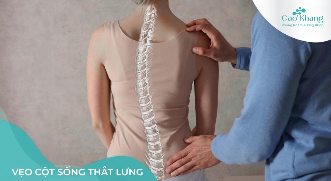 vẹo cột sống thắt lưng