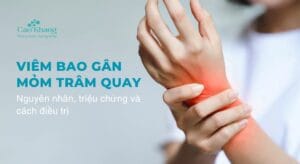 viêm bao gân mỏm trâm quay (1)