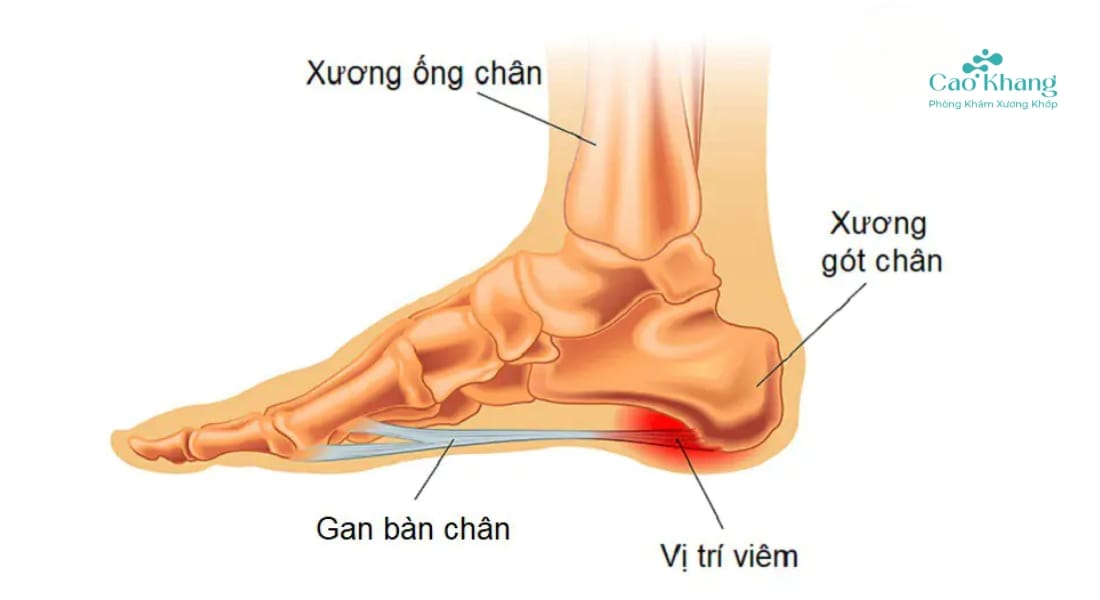 viêm cân gan chân (1)