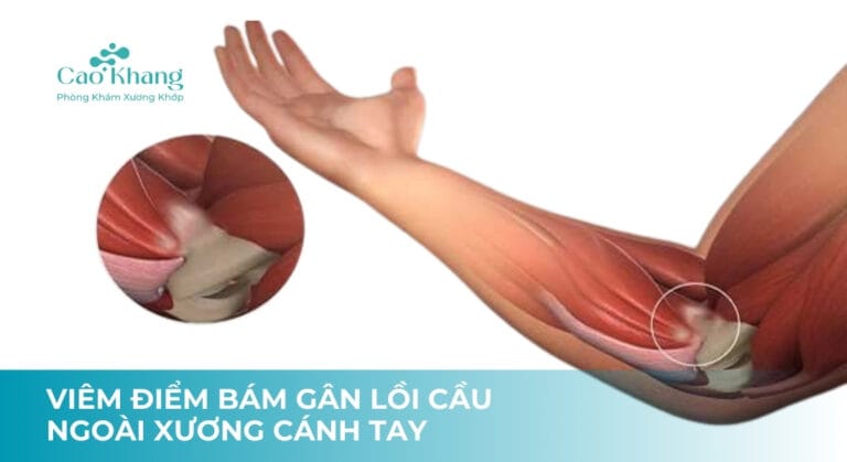 viêm điểm bám gân lồi cầu ngoài xương cánh tay