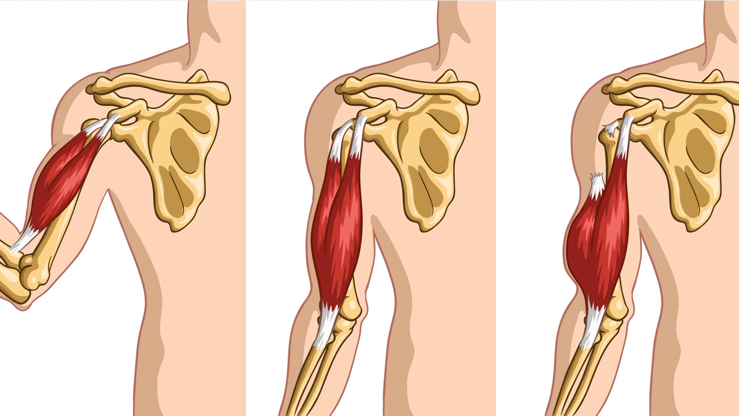 viêm gân cơ nhị đầu vai