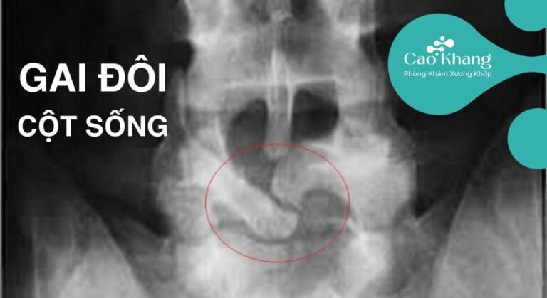 Gai đôi cột sống