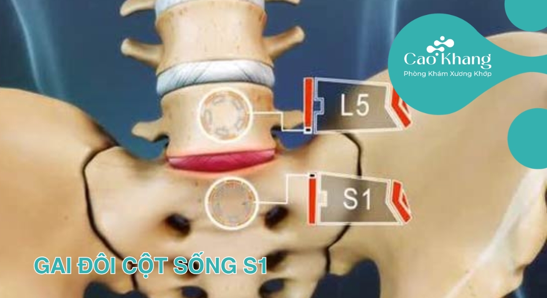 Gai đôi cột sống s1