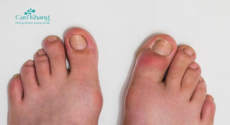 Trật khớp ngón chân