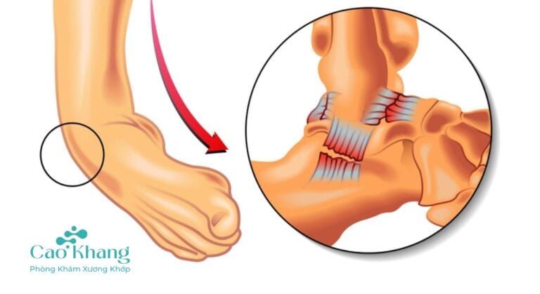 bong gân cổ chân
