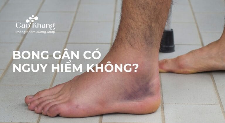 bong gân có nguy hiểm không