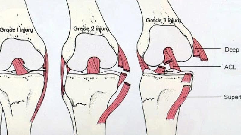 bong gân đầu gối