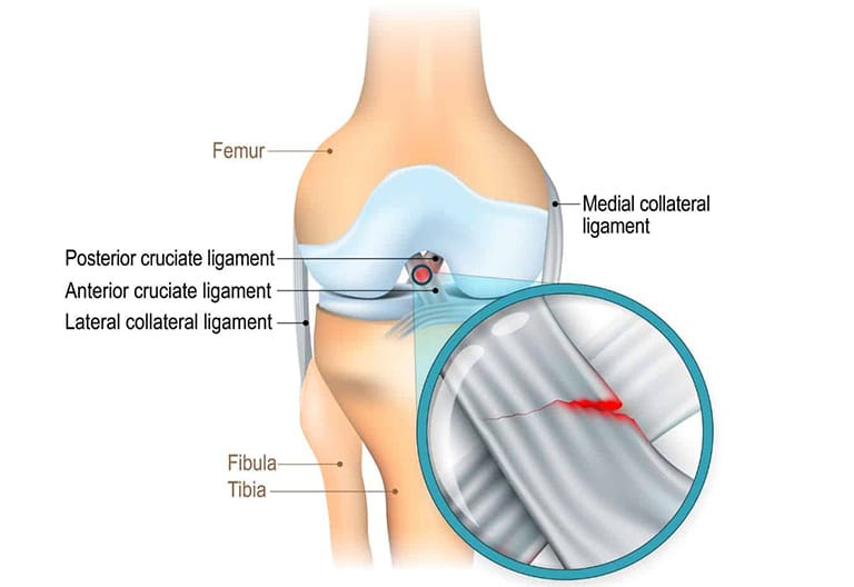 bong gân đầu gối