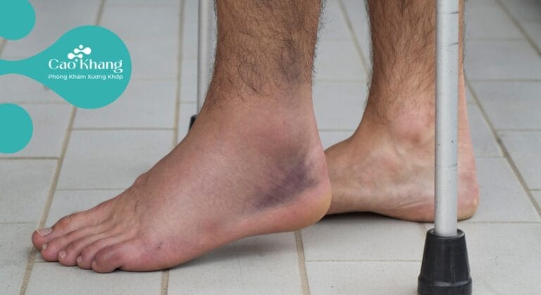 bong gân mắt cá chân