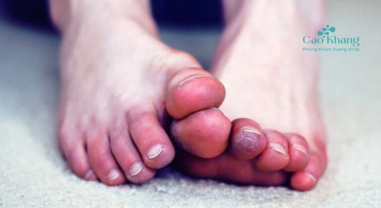 bong gân ngón chân