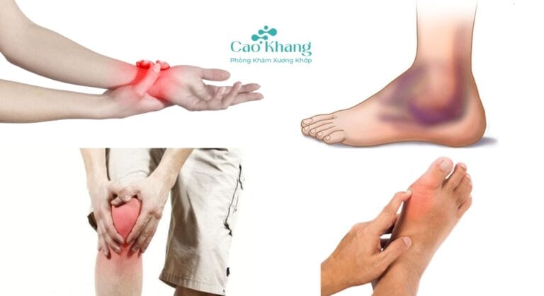 các khớp nào thường bị bong gân