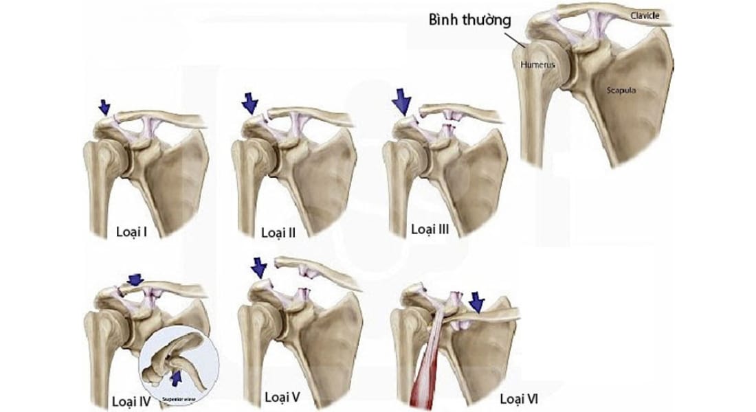 các mức độ trật khớp cùng đòn