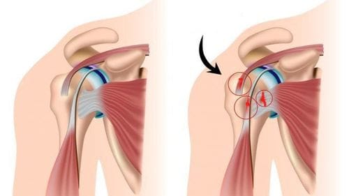 các loại trật khớp vai