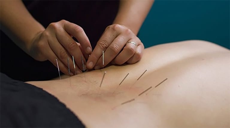 cách tị gai cột sống lưng: châm cứu