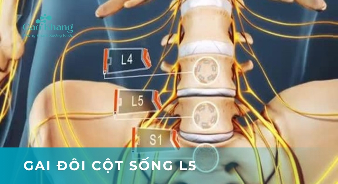 chữa gai đôi cột sống l5