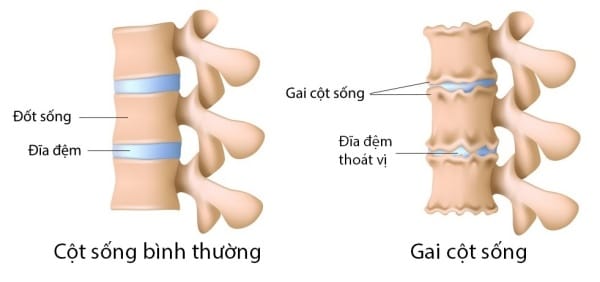 Cột sống thông thường và cột sống bị gai