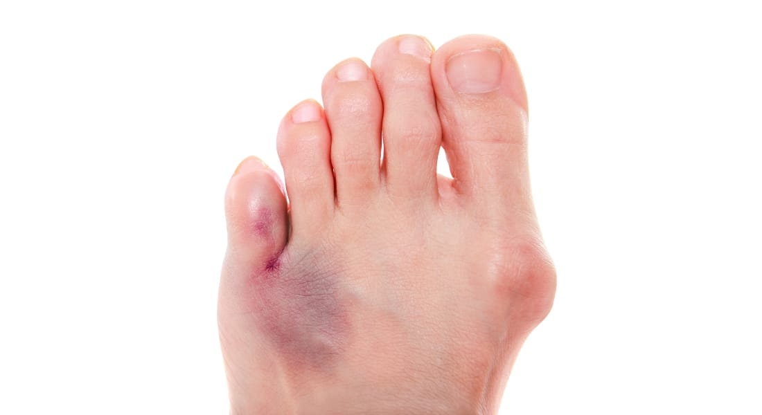 dấu hiệu trật khớp ngón chân