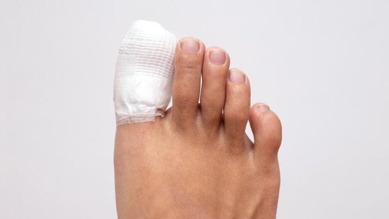 điều trị bong gân ngón chân