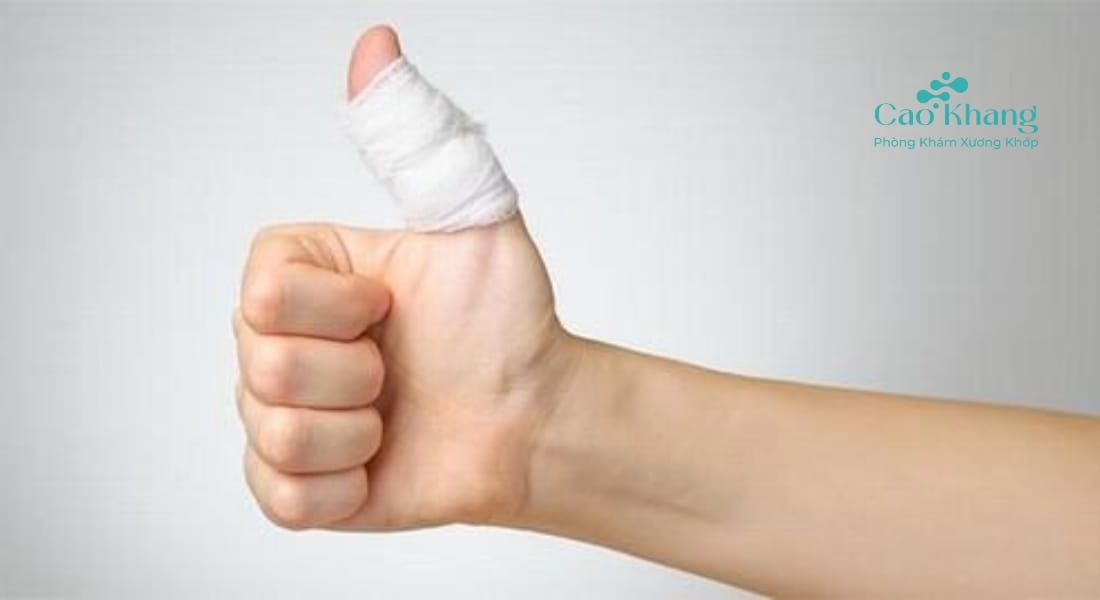 điều trị bong gân ngón tay