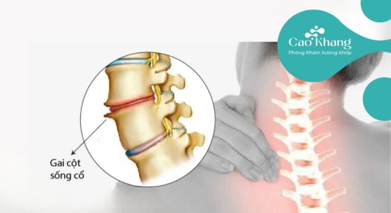 gai cột sống cổ