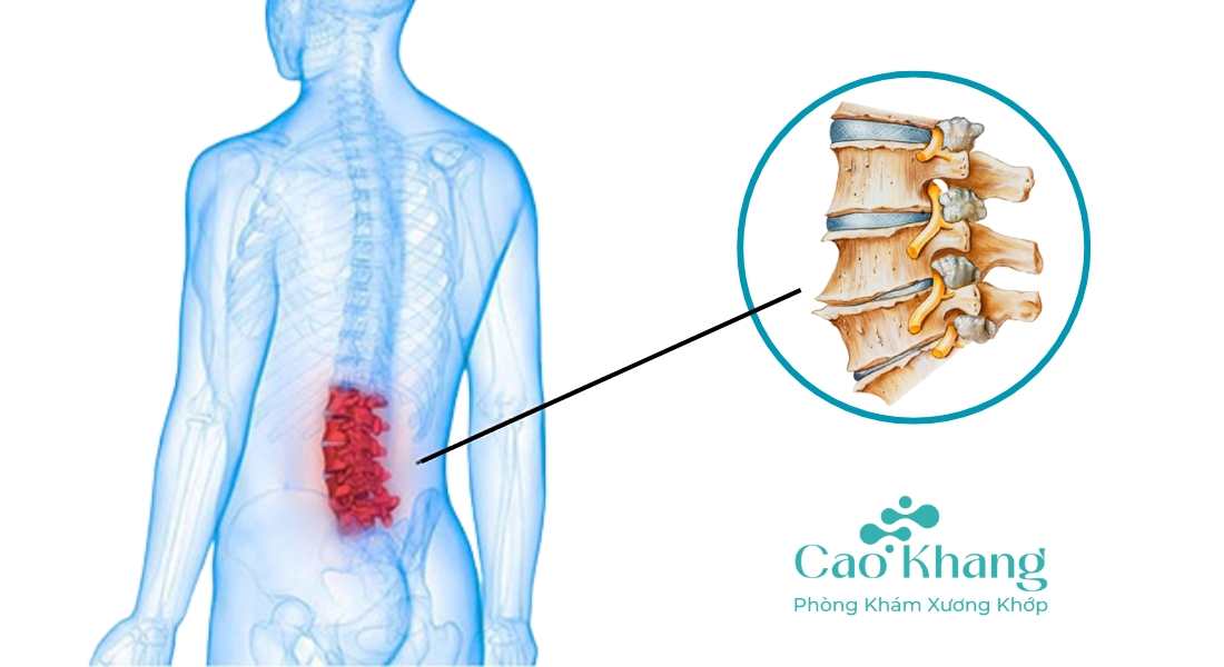 gai cột sống thắt lưng