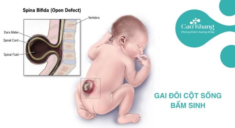 gai đôi cột sống bẩm sinh