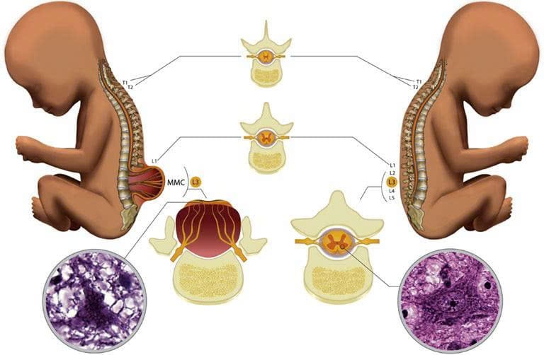 gai đôi cột sống bẩm sinh