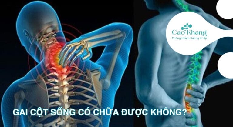 gai cột sống có chưa được không