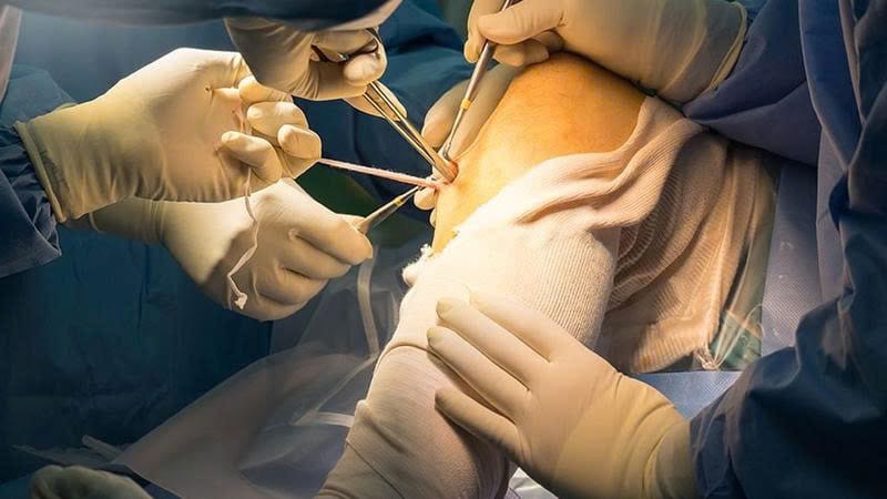 mổ hoặc tái tạo dây chằng