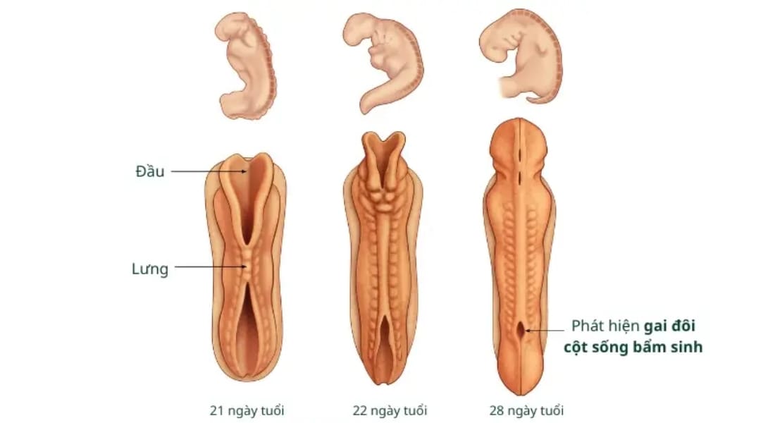phát hiện gai đôi cột sống bẩm sinh