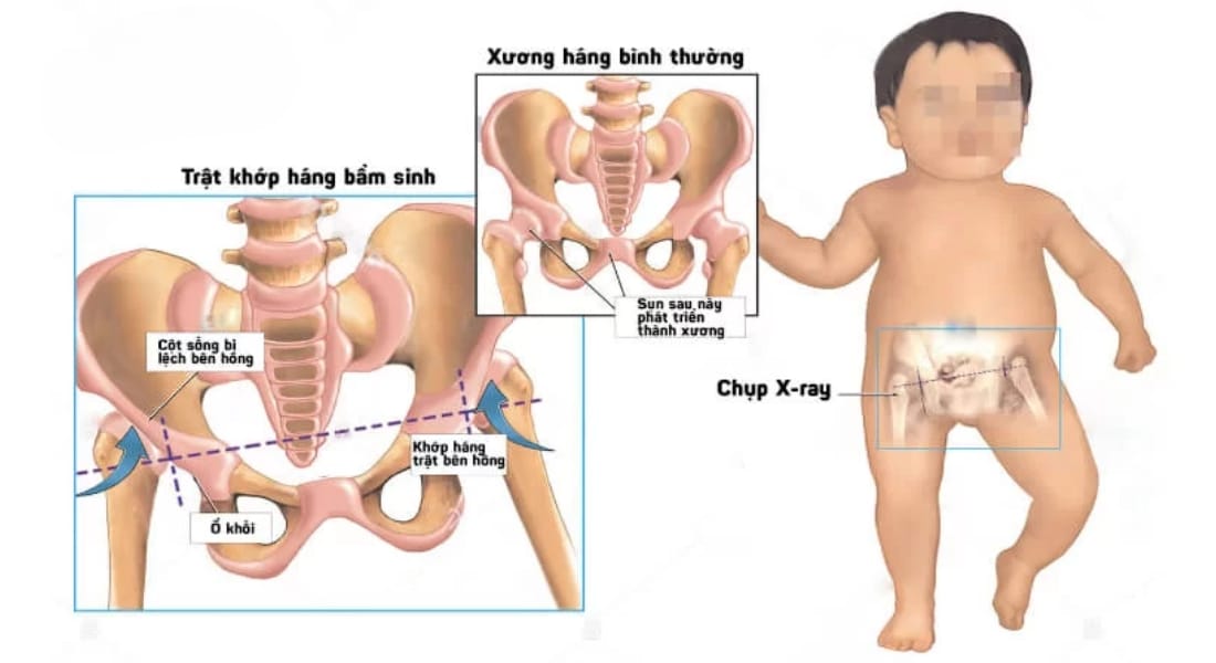 phẫu thuật tái tạo khớp háng