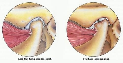 trật khớp hàm