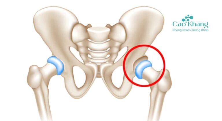 trật khớp háng