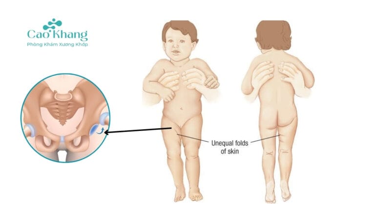 trật khớp háng bẩm sinh
