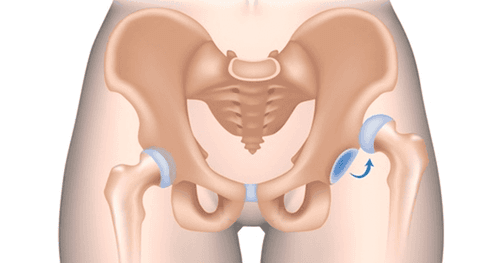 trật khớp háng bẩm sinh