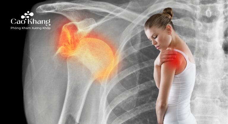 trật khớp vai (1)