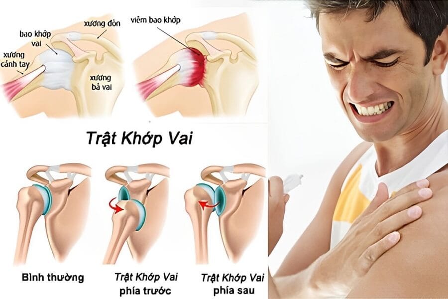 trật khớp vai