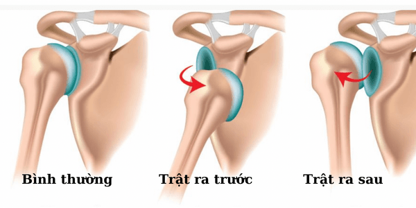 trật khớp vai