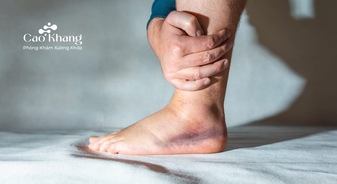 triệu chứng bong gân