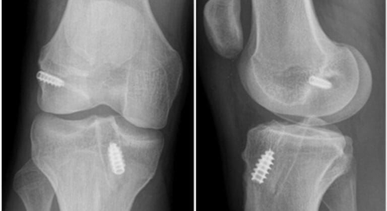 biến chứng sau mổ tái tạo dây chằng chéo trước