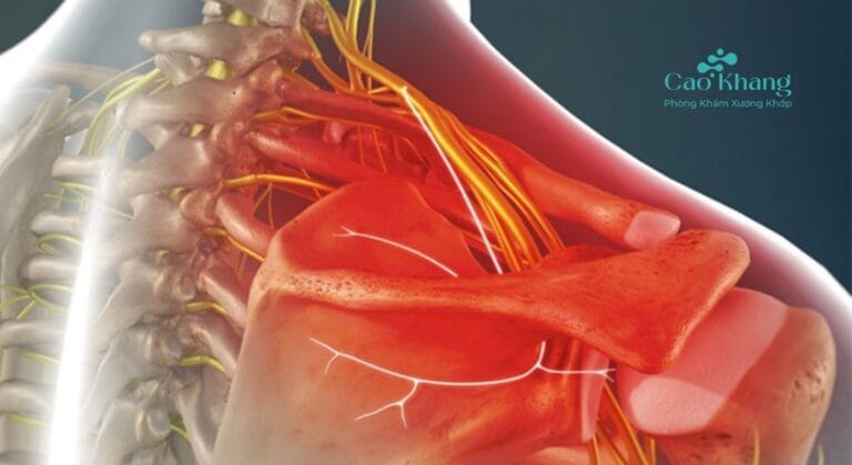 đau dây thần kinh vai gáy