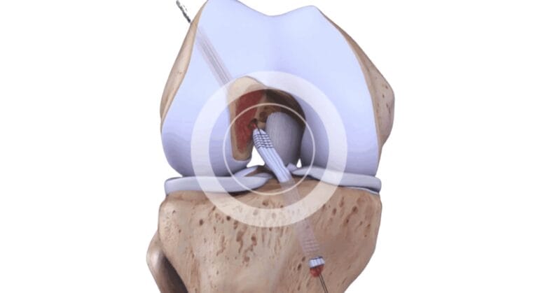 dây chằng nhân tạo