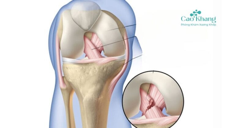 đứt bán phần dây chằng chéo trước