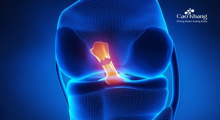 đứt dây chằng có đi được không