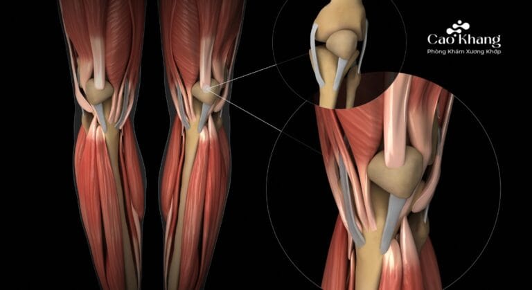 đứt dây chằng đầu gối